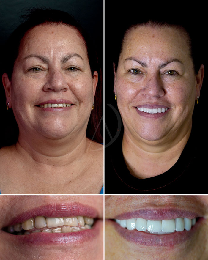 patient-1-smile-transformation