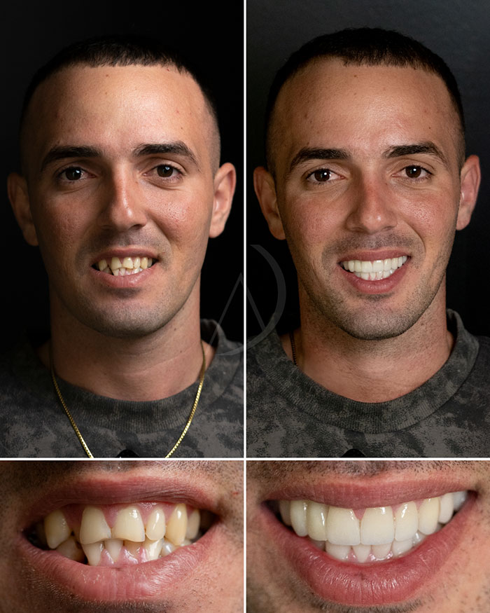 patient-10-smile-design-before-after