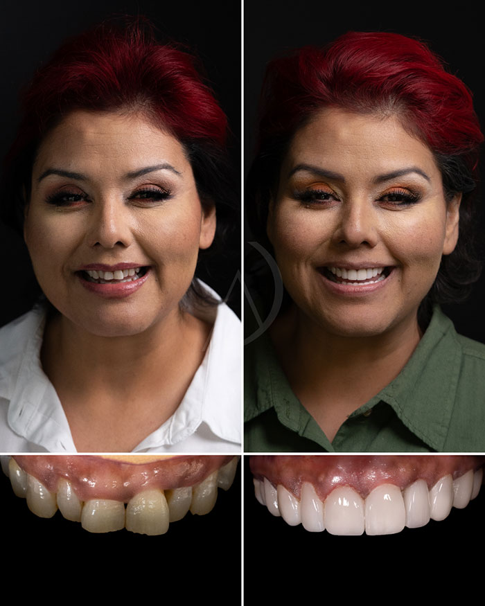 patient-2-smile-design