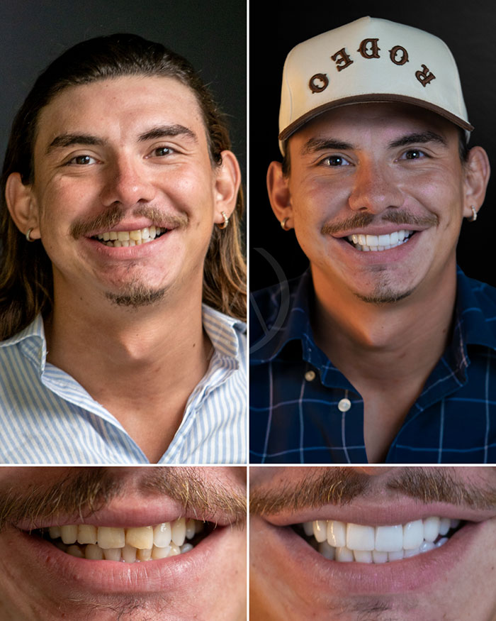 patient-3-smile-design-before-after
