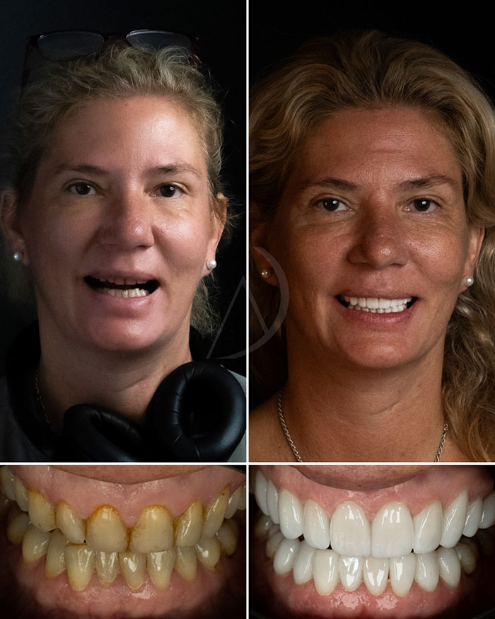 patient-4-smile-makeover