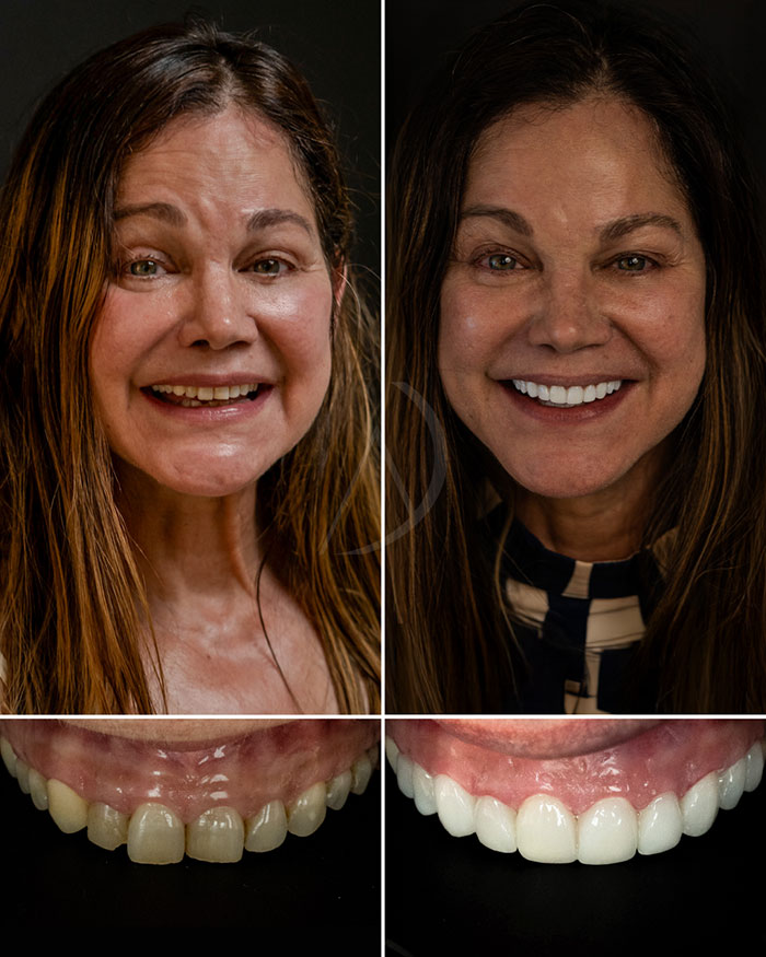 patient-5-smile-makeover-before-after