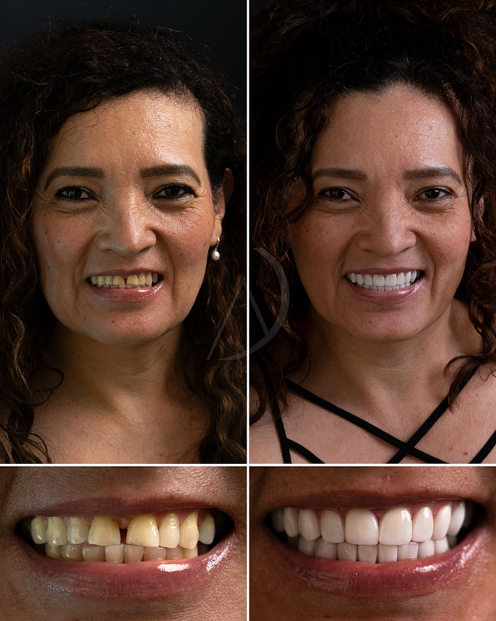 patient-6-smile-makeover-before-after