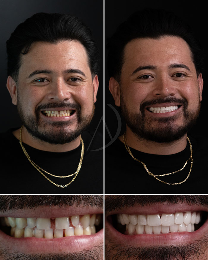 patient-7-smile-makeover-before-after