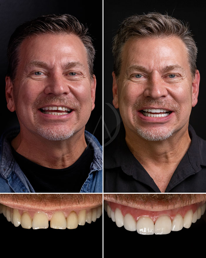 patient-8-smile-transformation