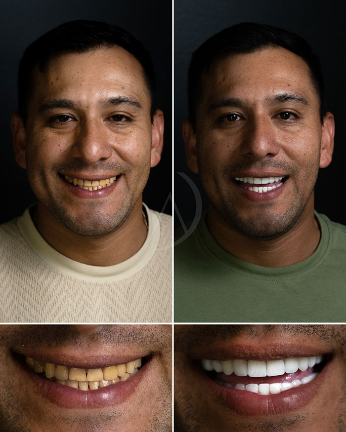 patient-9-smile-transformation
