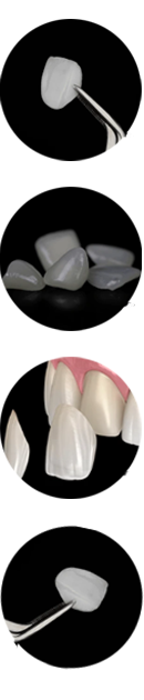 luminneers dental veneers